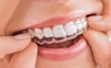 Những lưu ý đặc biệt khi niềng răng để khỏi 'tiền mất tật mang'