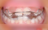 Bé gái 8 tuổi răng hô, môi trên vểnh, cằm nhỏ, trí tuệ giảm vì một thói quen xấu khi ngủ