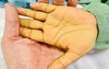 Sụt cân, mệt mỏi - cảnh báo sớm của ung thư gan ít ai ngờ