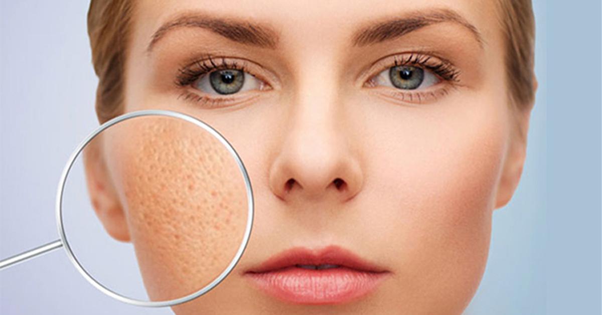 5 thắc mắc thường gặp về sẹo rỗ