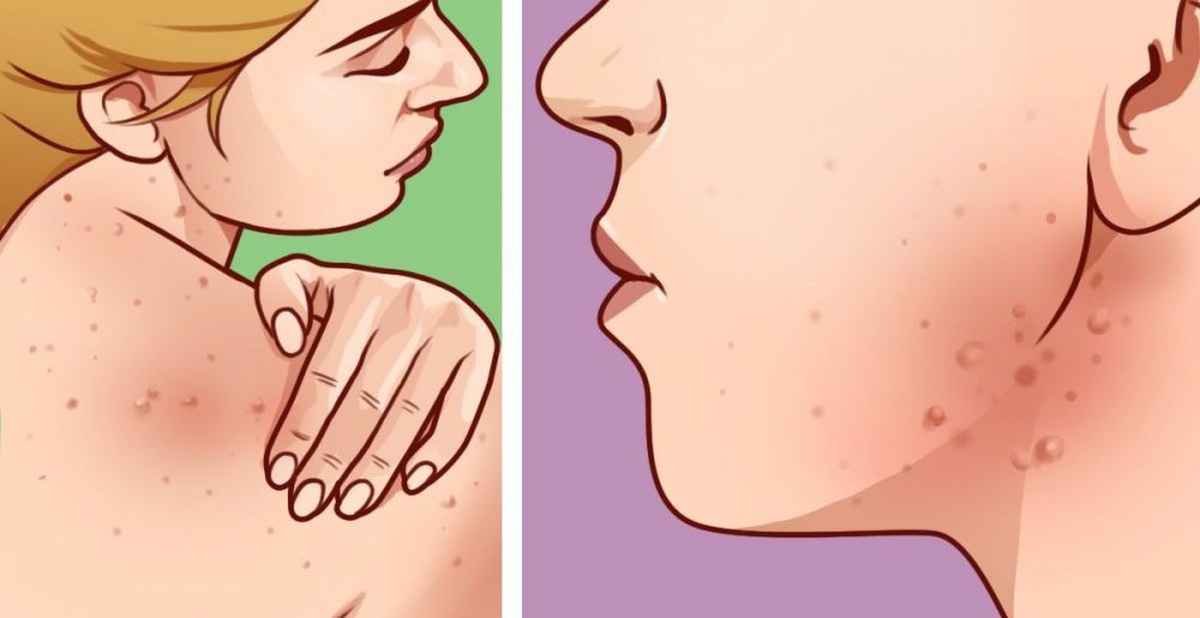 Tự nhiên mọc mụn ở chỗ này trên người, kiểm tra ngay bởi ...
