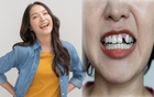 Trồng răng Implant: Đầu tư một lần, hiệu quả trọn đời, nâng cao chất lượng cuộc sống