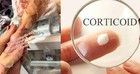 Choáng với cánh tay của cụ bà lạm dụng corticoid, da "mỏng tang", chạm nhẹ cũng chảy máu: Corticoid có trong sản phẩm nào?