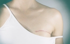 Tái tạo vú: Cuộc hồi sinh của người phụ nữ sau "vết sẹo vô hình"