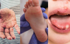 Bệnh tay chân miệng ở trẻ em: Dấu hiệu, nguyên nhân và cách điều trị