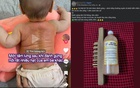 Hội mẹ bỉm hoang mang với trường phái "đánh gừng xuyên khung": Đánh gừng trị bách bệnh từ ốm sốt đến tăng chiều cao?