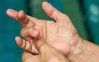 4 thay đổi ở ngón tay có thể là dấu hiệu ung thư phổi, hãy đi khám ngay!