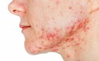 Sắp có vắc xin ngừa mụn trứng cá