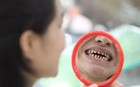 Mới 20 tuổi đã phải "hối hận" vì răng bị hủy hoại: Hóa ra thủ phạm là thức uống "ngon miệng", BS nói còn uống nữa sẽ viêm tủy răng