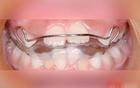 Bé gái 8 tuổi răng hô, môi trên vểnh, cằm nhỏ, trí tuệ giảm vì một thói quen xấu khi ngủ