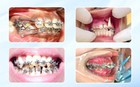Niềng răng hỏng: Nguy cơ tiềm ẩn đằng sau lựa chọn "giá rẻ"