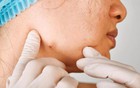 3 loại "mụn" này trên cơ thể có thể là ung thư, dù nam hay nữ, ở độ tuổi nào cũng đừng bỏ qua