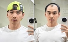 Chồng H'Hen Niê thay đổi thế nào sau cấy tóc trị hói đầu? Phương pháp này có giá bao nhiêu?