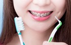 Những sai lầm trong chăm sóc răng miệng khi đang niềng: Cẩn trọng kẻo "mất cả hàm răng"