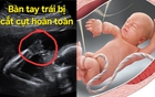 Thai nhi 21 tuần bị cắt cụt các ngón tay vì một thứ "sắc hơn dao" ngay trong bụng mẹ: Nguy hiểm nhưng khó phát hiện