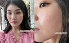 Tôi đã trẻ hóa da thành công nhờ collagen, mất đúng 2 năm để thay đổi làn da sẹo rỗ