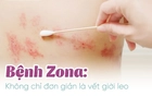 Zona thần kinh: Căn bệnh dễ gặp, biến chứng khó lường