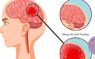 Bệnh não mô cầu có thể gây tử vong nhanh, chuyên gia cảnh báo những dấu hiệu nguy hiểm