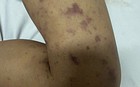 Cháu tử vong do não mô cầu, chú ruột 40 tuổi cũng nhiễm bệnh