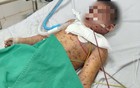 Bé trai 6 tuổi nguy kịch vì biến chứng nặng từ thủy đậu
