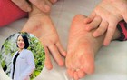BS khoa Nhi chỉ ra dấu hiệu virus tay chân miệng bắt đầu tác động vào tế bào thần kinh, cha mẹ tuyệt đối không được bỏ qua