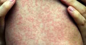 Dịch sởi bùng phát tại một xã