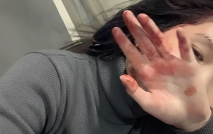 6 bất thường ở bàn tay đang ám chỉ lượng đường trong máu vượt ngưỡng an toàn, tiếc là rất ít người để ý!