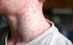 Hành động nhanh và cẩn thận là chìa khóa giúp con tránh mắc bệnh sởi!