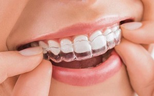 Những lưu ý đặc biệt khi niềng răng để khỏi 'tiền mất tật mang'
