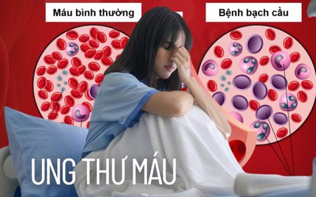 Nhiều người bị ung thư máu: Làm thế nào để phòng bệnh?