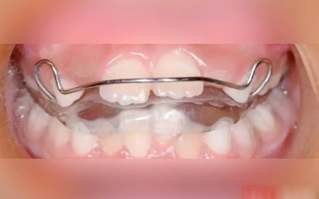 Bé gái 8 tuổi răng hô, môi trên vểnh, cằm nhỏ, trí tuệ giảm vì một thói quen xấu khi ngủ