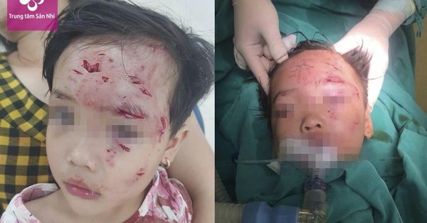 Bé gái 3 tuổi bị chó nhà hàng xóm cắn thương tâm