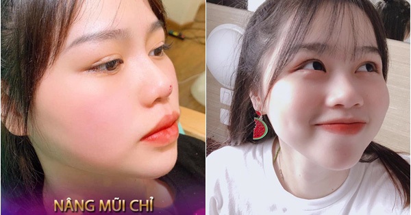 Vừa bị một spa lấy ảnh không xin phép để quảng cáo dịch vụ nâng mũi, hot girl Huỳnh Anh đăng ngay story chứng minh mình