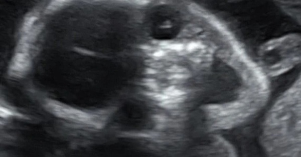 The mother panicked when she saw the ultrasound image of the fetus in her stomach