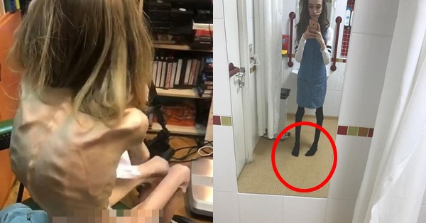 Teenage girl is skinny because of eating disorder