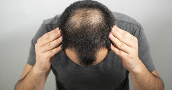 Rụng tóc do nội tiết tố nam Androgenic Alopecia