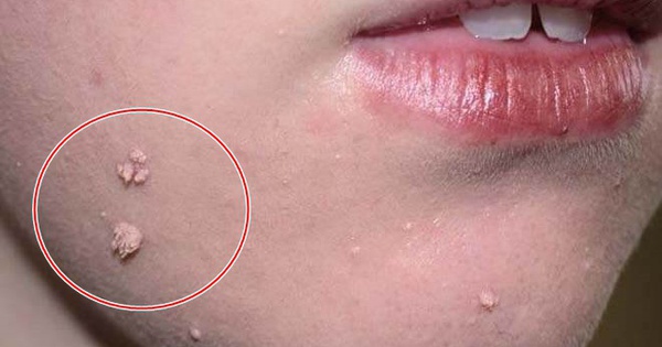 Women with pimples in these 3 locations on the body beware of HPV infection