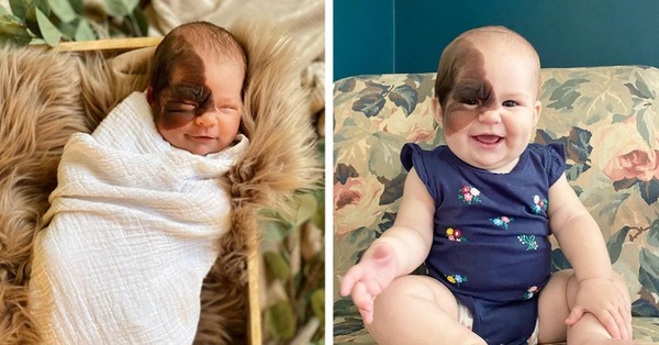 Baby born with rare birthmark on face