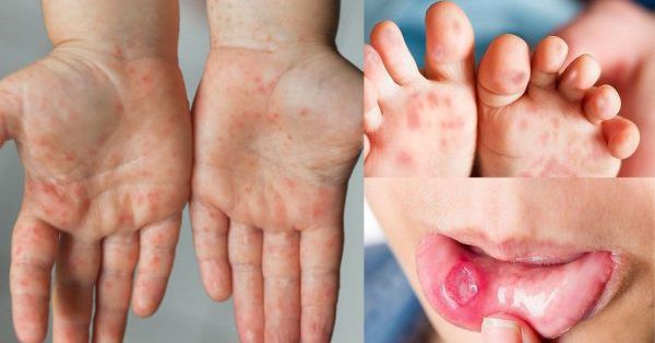 There have been 5,545 cases of hand, foot and mouth disease, 1 death, the Ministry of Health predicts that the epidemic may increase