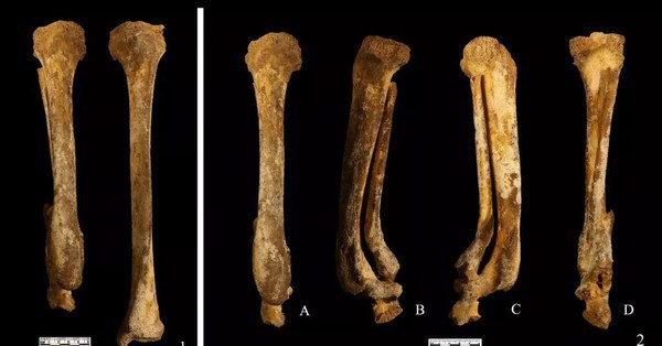 Ancient skeletons reveal the punishment of cutting off the feet of Chinese women 3,000 years ago