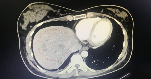 Abdominal pain thought due to post-Covid-19 , went to see a liver abscess