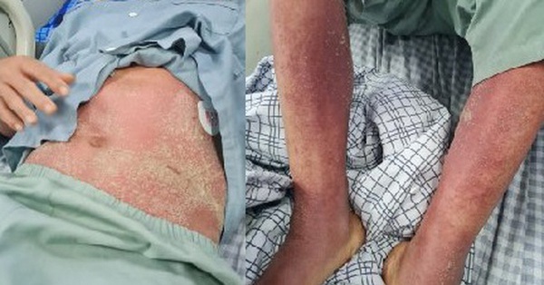 2 patients with meningitis, bacteremia caused by swine streptococcus