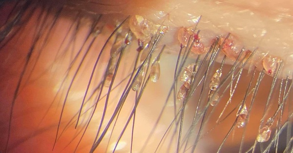 Nearly 100 pubic lice nest on male patient’s eyelid