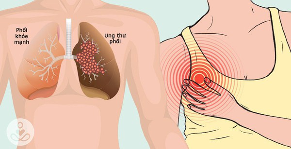 Không chỉ có ho, đây còn là 5 dấu hiệu 