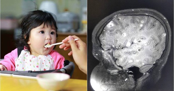 Rùng mình với hình ảnh hàng trăm ấu trùng sán dây lợn trong não trẻ chỉ vì hàng ngày cha mẹ cho ăn uống theo cách này