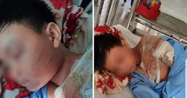 Xôn xao thông tin bé trai 8 tuổi bị bố ruột đánh đập, đổ nước sôi lên người đến mức nhập viện cấp cứu?