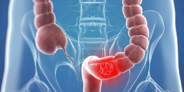 Ung thư đại trực tràng - chỉ 6 tháng kể từ khi chẩn đoán đến khi qua đời: 5 triệu chứng có thể là ruột đang
