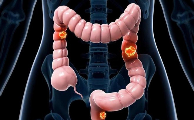 Ung thư đại trực tràng - chỉ 6 tháng kể từ khi chẩn đoán đến khi qua đời: 5 triệu chứng có thể là ruột đang