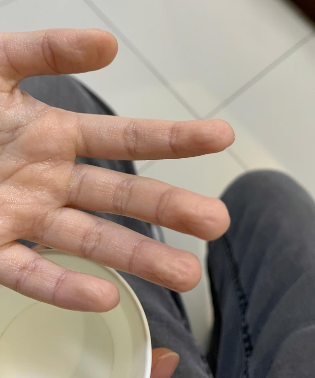 Bé gái gần 5 tuổi được bố đưa đến khám vì ho kéo dài hơn 2 năm không dứt, bác sĩ yêu cầu bé nhúng tay vào 2 cốc nước và kết quả vỡ òa - Ảnh 2.