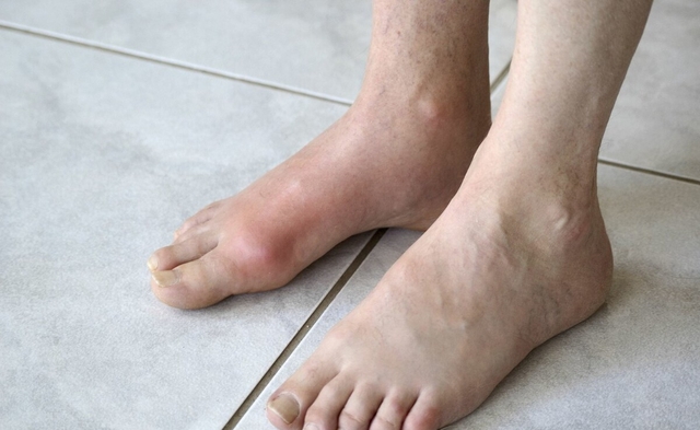 Có 2 dấu hiệu đi lại này thì cảnh giác bệnh suy thận sắp 